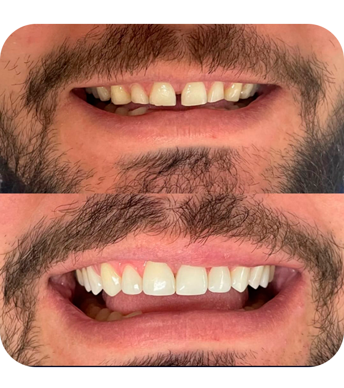 Comparação de sorrisos antes e depois
