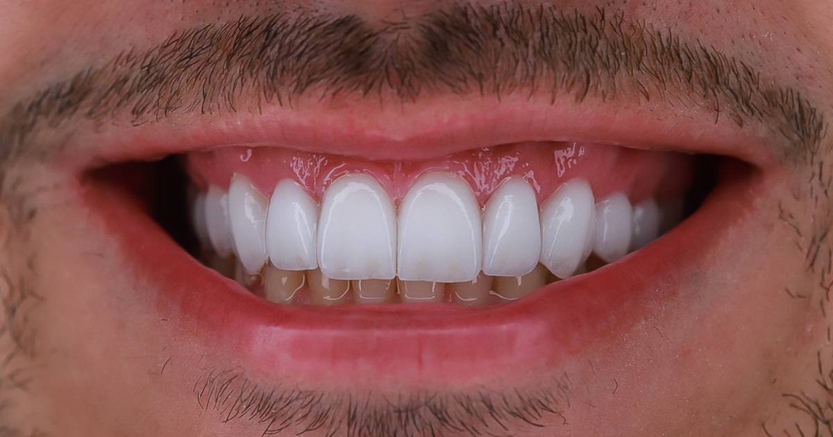 Protocolo sobre implantes